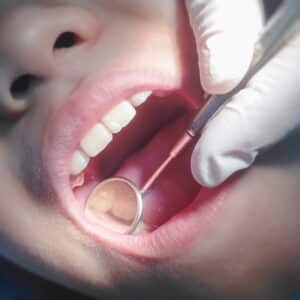 white dental fillings