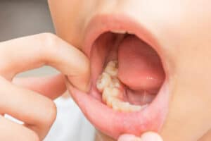 Pediatric Tooth Extractions